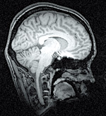 High resolution image of the midsagittal plane of the brain obtained by nuclear magnetic resonance imaging.